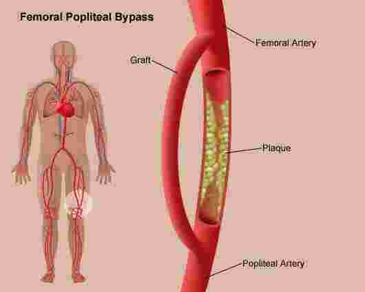 Bypass Meaning and Definition