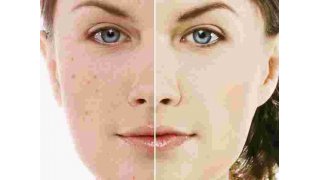 Acne Meaning and Definition