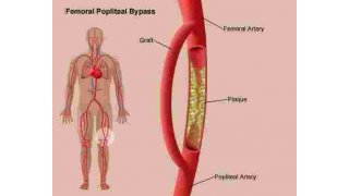 Bypass Meaning and Definition